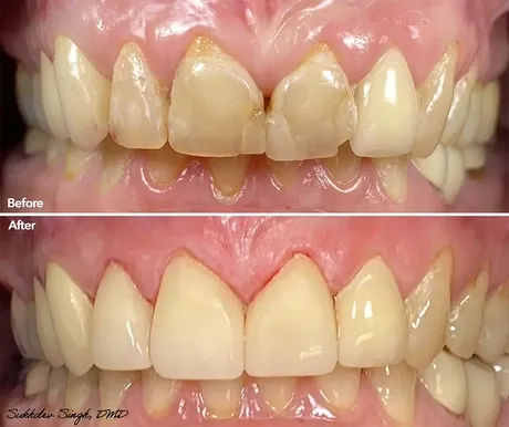 patient before and after crowns at Saugus Smiles