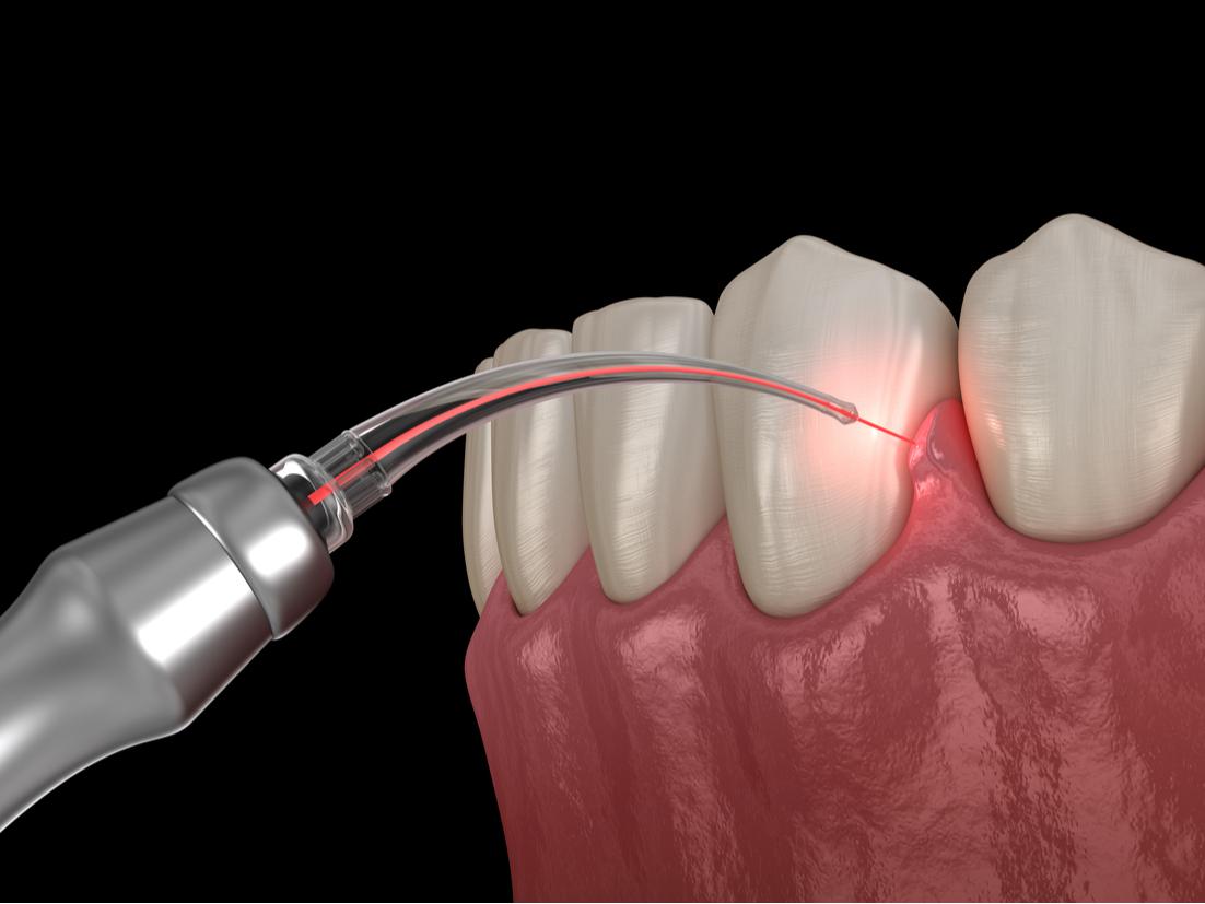 Laser Gum Treatment Saugus, MA