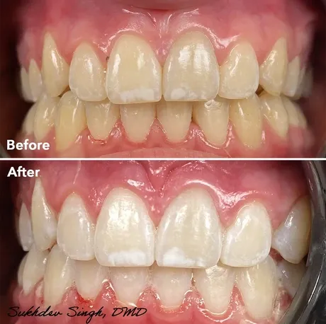 before and after teeth whitening